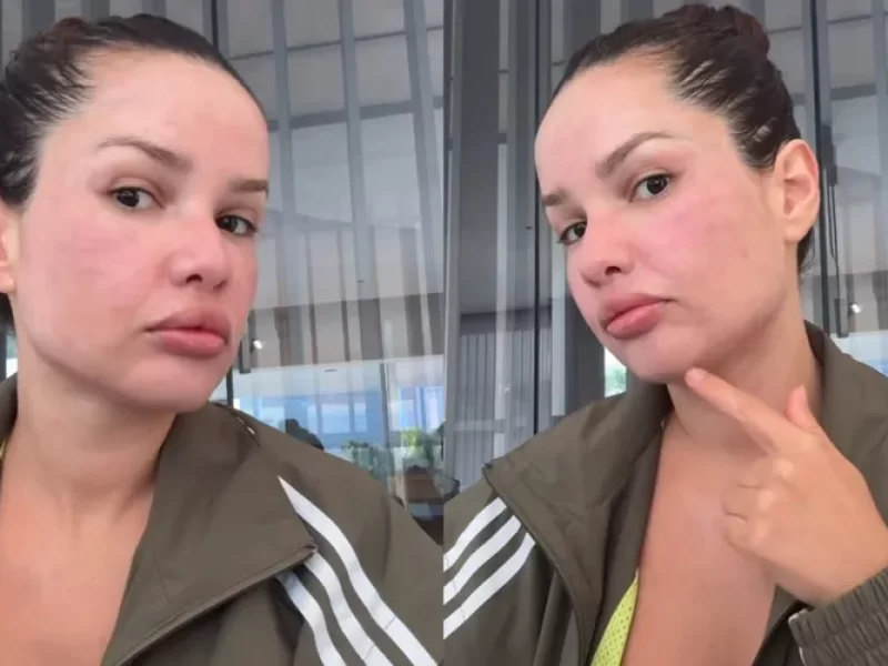 Deu-ruim-Juliette-mostra-rosto-inchado-apos-tratam0131014300202507231859-ScaleOutside-1