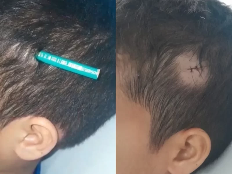 Menino-tem-lapis-fincado-na-cabeca-por-colega-de-s0131178300202508212034-1