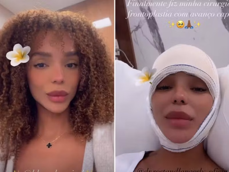 brunna-frontoplastia